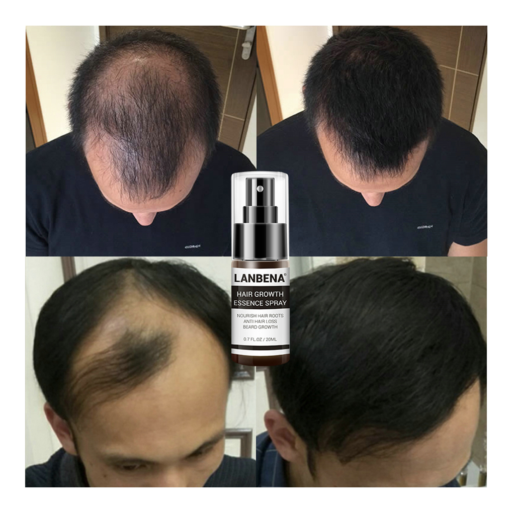 LANBENA 20ml Hair Growth Essen - Hair Care Essence Oil Spray recension och pris
